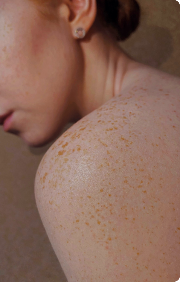 View of a woman's left shoulder with freckled skin